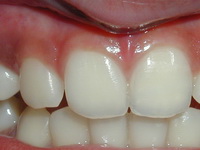 восстановление коронок зубов